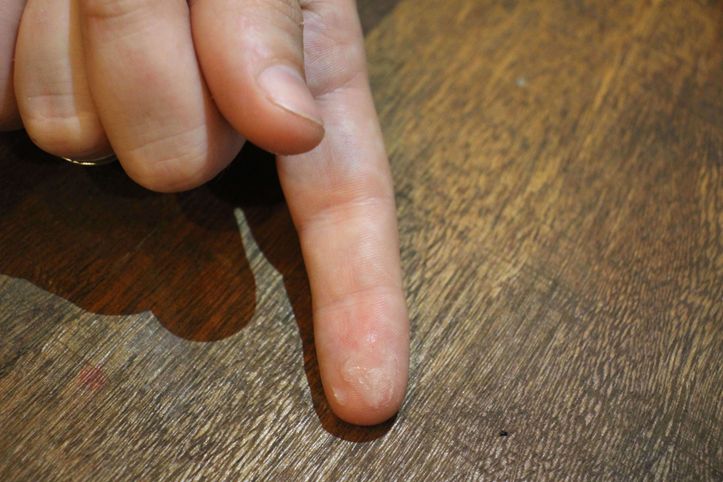 How To Get Super Glue Off Your Fingers